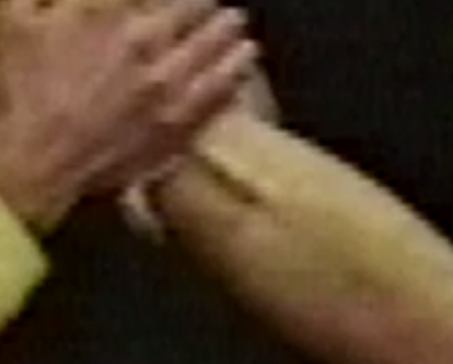 Tube can be seen protruding from left arm